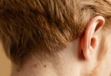 Удаление бородавок: современные подходы и методы